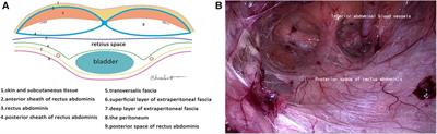 Using the concept of preperitoneal membrane anatomy in total extraperitoneal prosthesis: a preliminary report